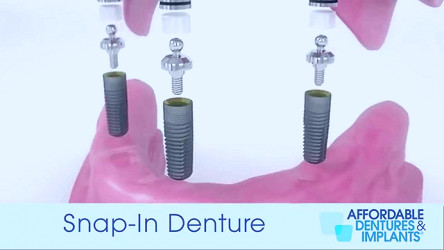 Dental Implant l Hebron, KY l Hebron Dental Center